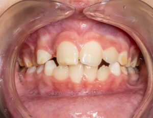 枚方市樟葉の歯医者、たかぎ歯科クリニックで、子供でもホワイトニング可能？歯の変色の原因と安全に白くする方法について解説