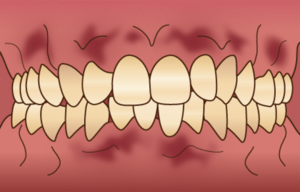 枚方市樟葉の歯医者、たかぎ歯科クリニックで歯ぐきが紫色なのは何が原因？治療法や予防法も解説